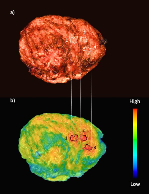 Data from fluorescence imaging can improve outcomes in head and neck cancer surgery: study 