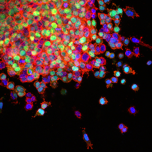 lung cancer metastasis